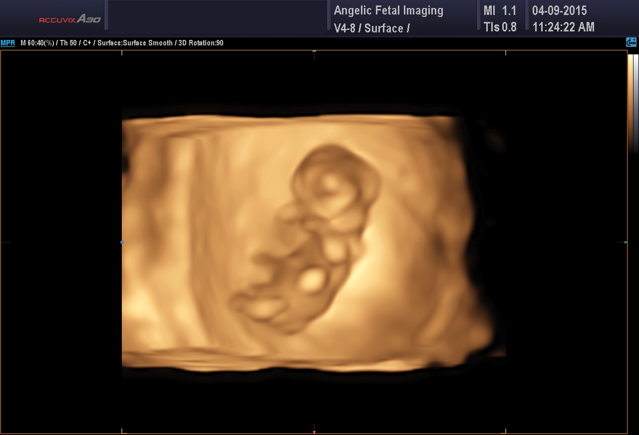 3D Photos | First Trimester