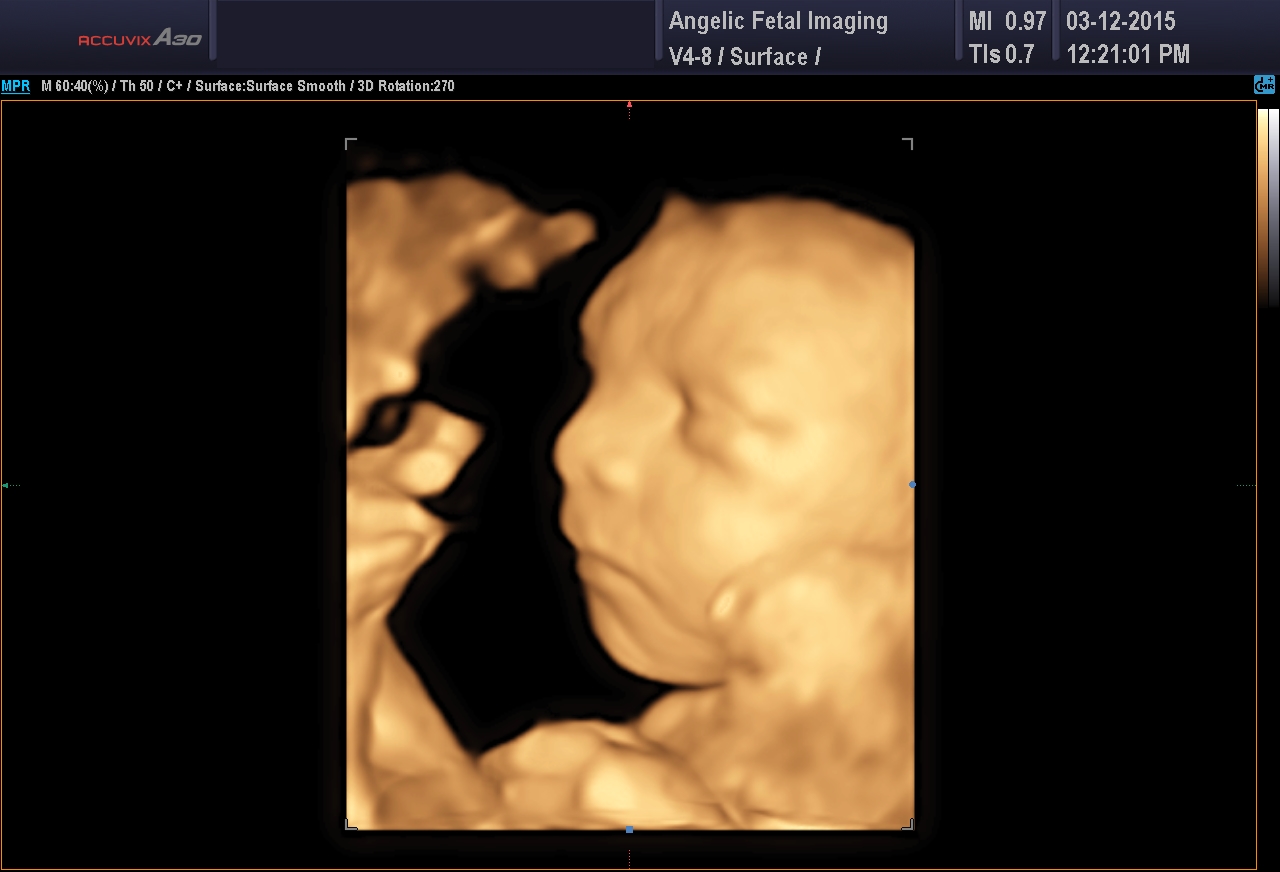 3D Photos | Second Trimester