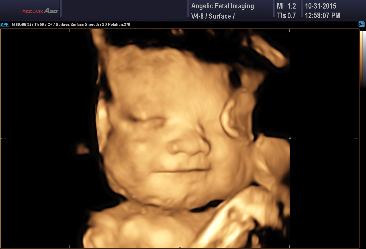 3D Photos | Third Trimester