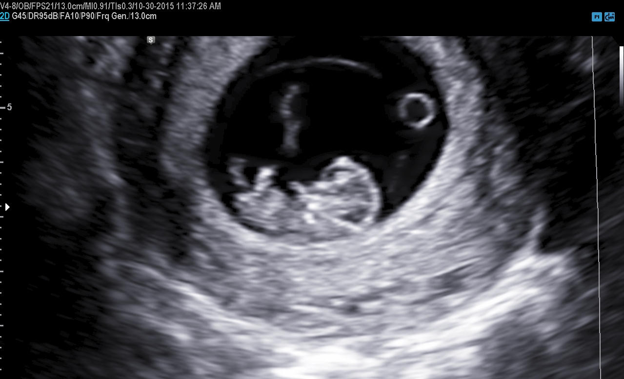 2D Photos | 1st Trimester